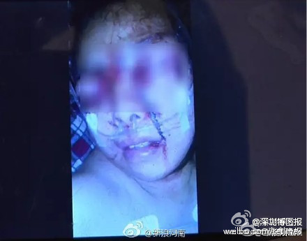 受伤的妻子